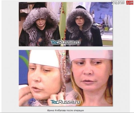 Ирина Александровна Агибалова после операции
